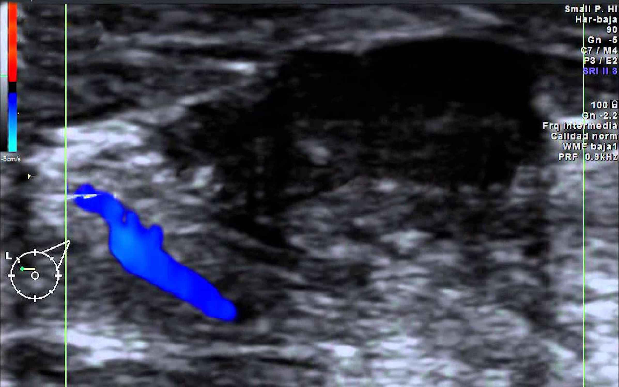 doppler ultrasound