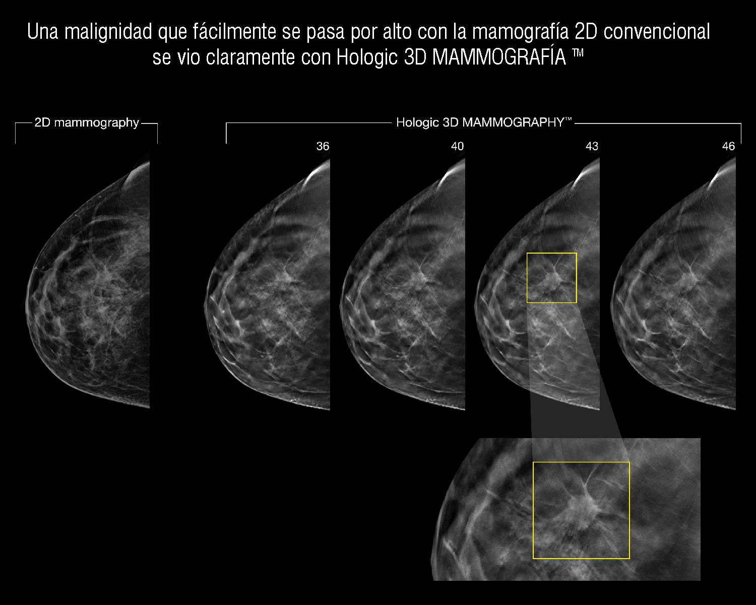 tomosynthesis ultrasound