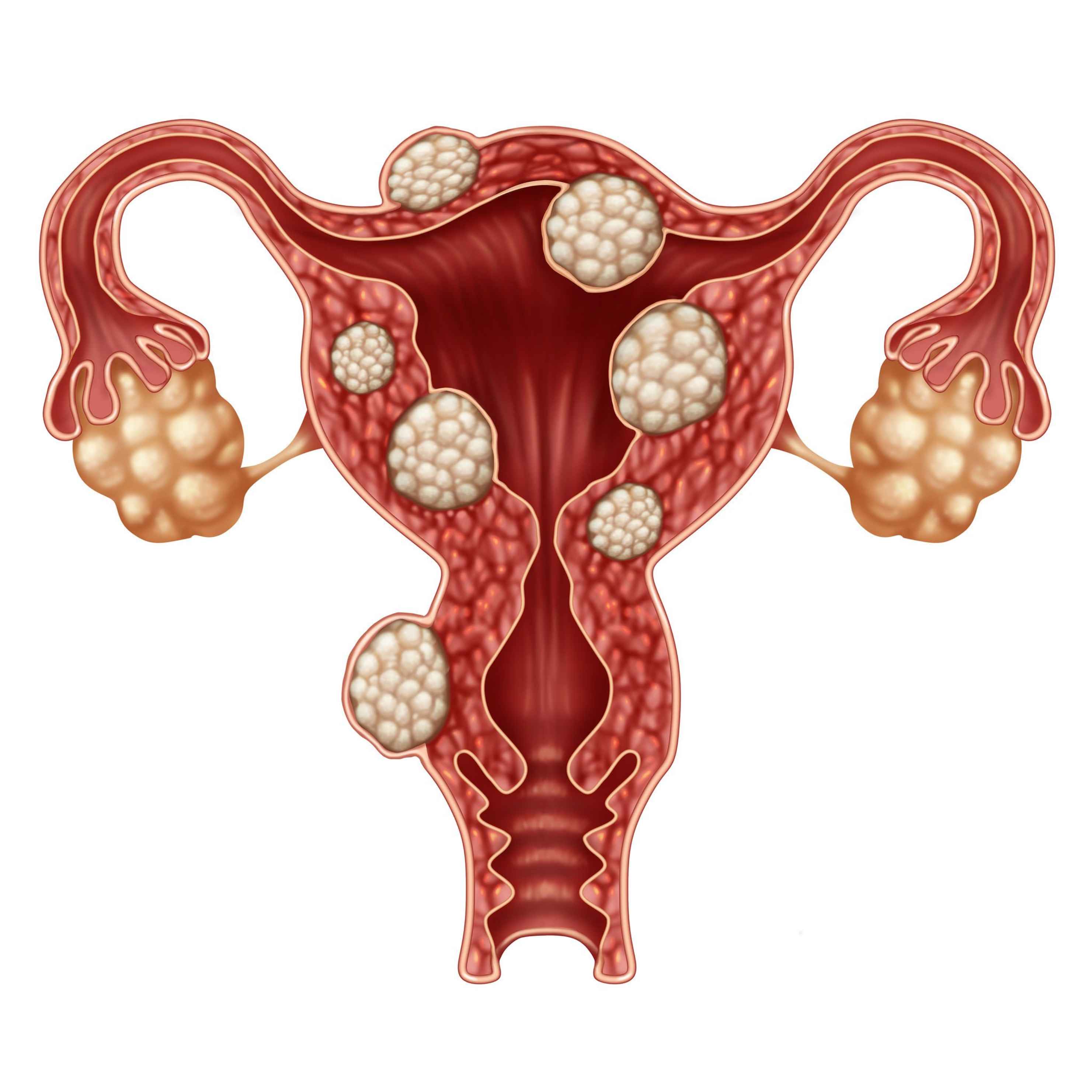 Embolizacion de miomas