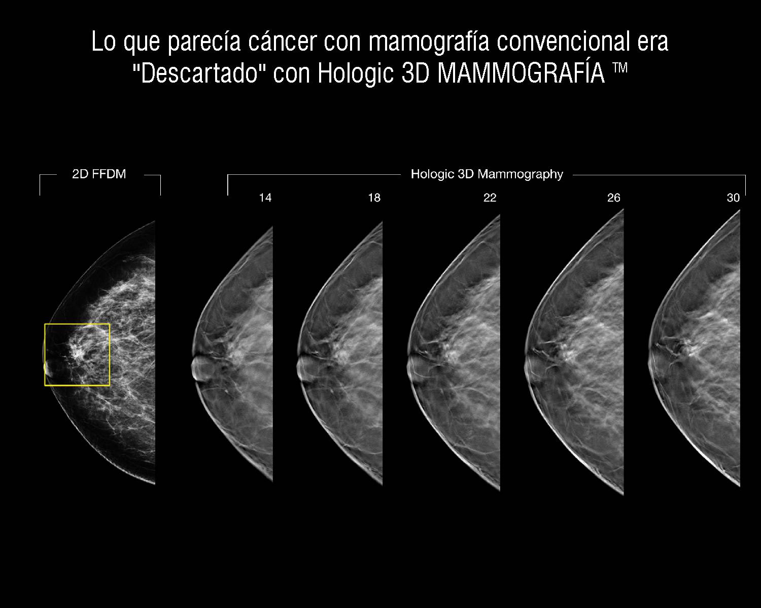 tomosynthesis ultrasound