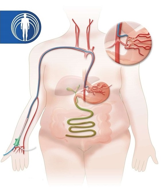 Bariatrica imagen descriptiva